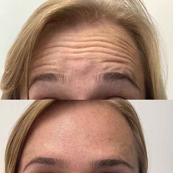 BOTOX for forehead lines, before and after at Coastal Medical Aesthetics
