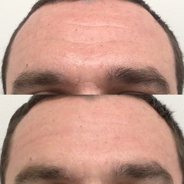 BOTOX for forehead lines, before and after at Coastal Medical Aesthetics