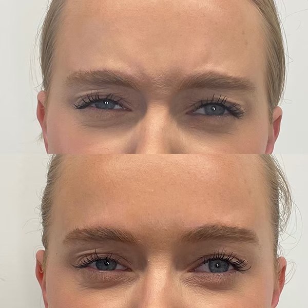 BOTOX for frown lines, before and after at Coastal Medical Aesthetics