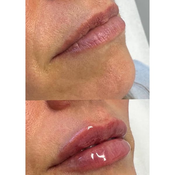 Juvederm Ultra lip filler, before and after at Coastal Medical Aesthetics