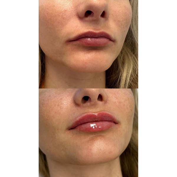 Juvederm Ultra lip filler, before and after at Coastal Medical Aesthetics