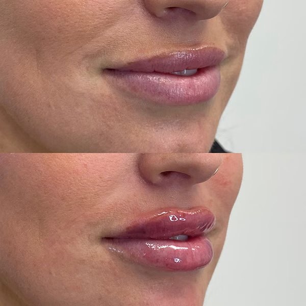 Juvederm Ultra lip filler, before and after at Coastal Medical Aesthetics