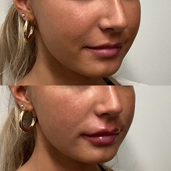 Juvederm Ultra Plus lip filler, before and after at Coastal Medical Aesthetics